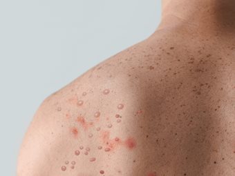 Ευλογιά των Πιθήκων: Συνολικά 85 κρούσματα έχουν καταγραφεί στην Ελλάδα Ευλογιά των Πιθήκων: Συνολικά 85 κρούσματα έχουν καταγραφεί στην Ελλάδα