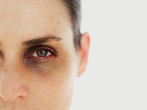 Μαύροι κύκλοι κάτω από τα μάτια: Πότε δηλώνουν απλή κούραση και πότε χρειάζονται πρόσθετες θεραπείες Μαύροι κύκλοι κάτω από τα μάτια: Πότε δηλώνουν απλή κούραση και πότε χρειάζονται πρόσθετες θεραπείες