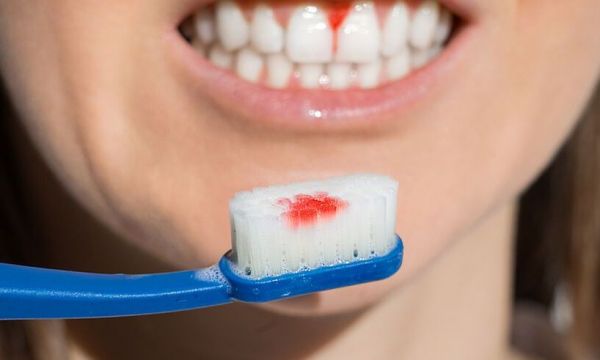 Με ποιες σοβαρές ασθένειες συνδέεται η Ουλίτιδα- Περιοδοντίτιδα; Με ποιες σοβαρές ασθένειες συνδέεται η Ουλίτιδα- Περιοδοντίτιδα;