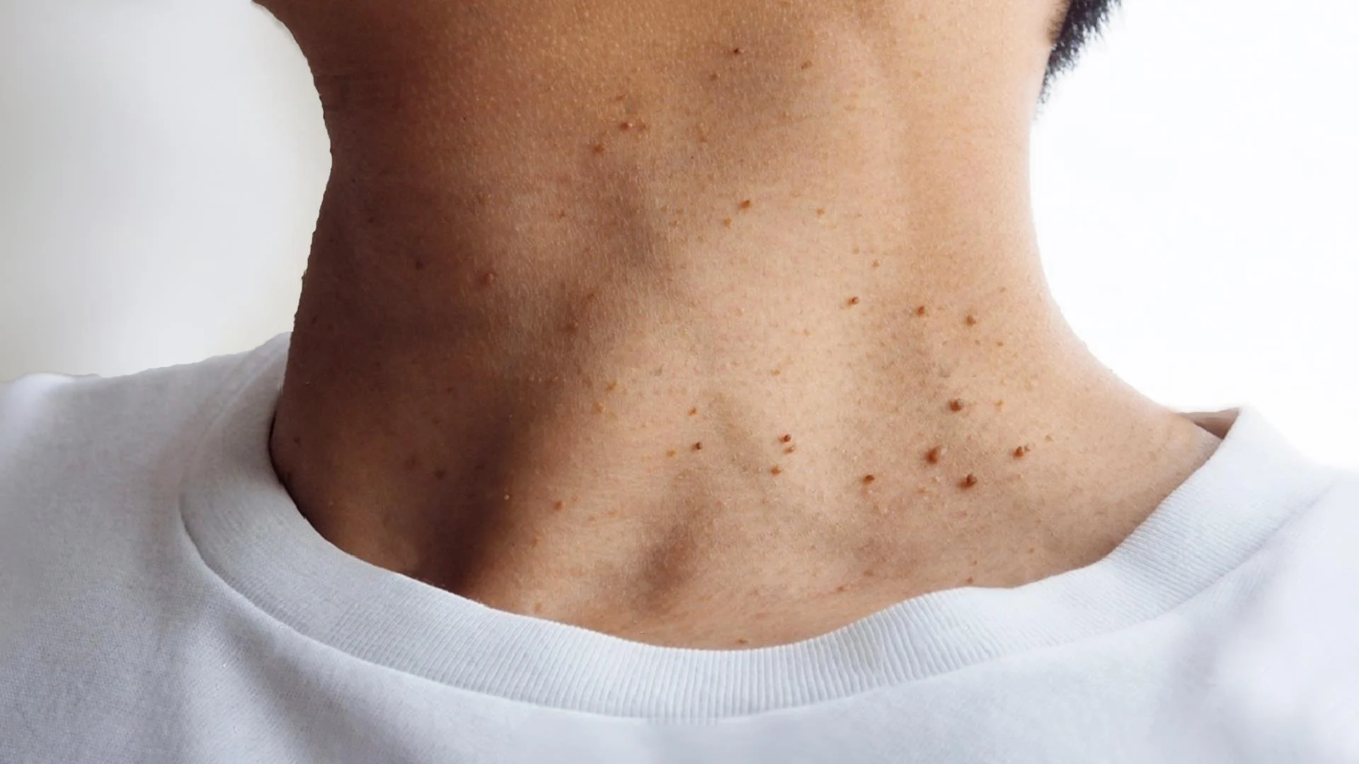 Δερματικά θηλώματα κυρίως γύρω από τον λαιμό: Πώς τα αντιμετωπίζουμε άμεσα; Δερματικά θηλώματα κυρίως γύρω από τον λαιμό: Πώς τα αντιμετωπίζουμε άμεσα;